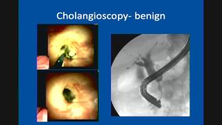 Primary Sclerosing Cholangitis Update in Management [upl. by Cleodell480]