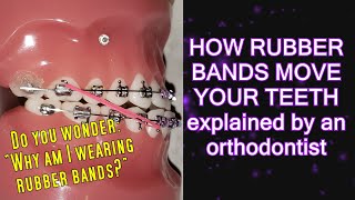 How elastics  rubber bands move teeth time lapse  Braces Explained [upl. by Golub]