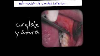 INCLUSIONES DENTARIAS Y OSTEOTOMÍA EN CIRUGÍA BUCAL [upl. by Alikee]