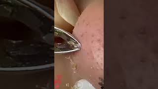 Skincare  Blackheads Removal 268 tweezers skincare blackheads blackheads [upl. by Ajram94]