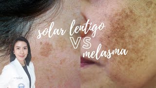 Whats the difference Solar Lentigo vs Melasma [upl. by Leonardo]