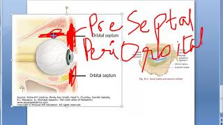 Ophthalmology 417 a Orbital Infection Orbital Cellulitis PreSeptal Post Septal Eye Swelling [upl. by Elleinnod]