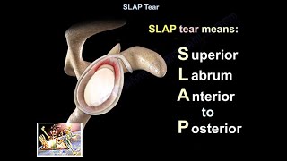 SLAP Tear  Everything You Need To Know  Dr Nabil Ebraheim [upl. by Home604]