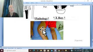 Orthopaedic in Arabic 63  Osteogenic sarcoma  clinical pictures amp treatment   by DrWahdan [upl. by Aidnic]