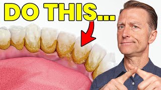 The 1 Top Remedy for Dental Plaque TARTAR [upl. by Rehnberg]