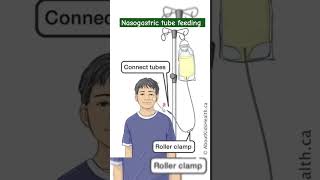 Nasogastric tube feeding  Ryles tube mbbs neet motivation aiims medical hospital [upl. by Bern83]