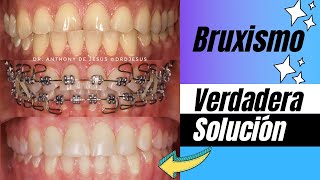 TRATAMIENTO PARA EL BRUXISMO CON BRACKETS ANTES Y DESPUÉS  CASO EXTREMO REAL [upl. by Eednar]