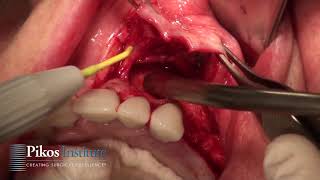 Maxillary Ridge Split  Pikos Institute [upl. by Bakerman890]