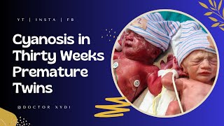 Cyanosis in Thirty weeks premature twins [upl. by Sirovat]