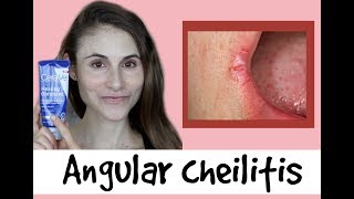 Angular cheilitis causes amp treatments a QampA with dermatologist Dr Dray [upl. by Eidnew]