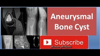 Aneurysmal Bone Cyst [upl. by Epifano]