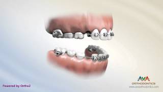 Orthodontic Treatment for Kids  2x4 Braces [upl. by Auhsaj543]