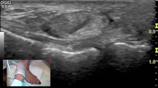 Ultrasound tutorial  Imaging of the Calcaneofibular Ligament [upl. by Airdnola]