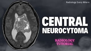 Central Neurocytoma Radiology Tutorials [upl. by Spiegelman]