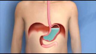 Heartburn Acid Reflux GERDMayo Clinic [upl. by Shell]