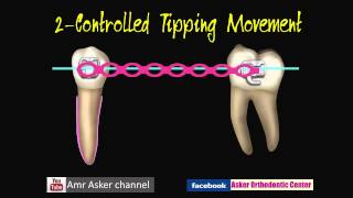 Types of Orthodontic Tooth movement [upl. by Esilahs441]