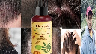 Deyga Hair Growth Oil  Honest Review [upl. by Wells]