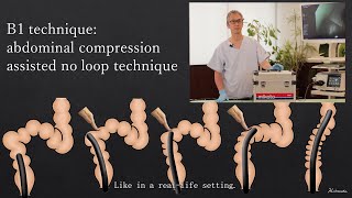 Colonoscopy Insertion Technique with Mikoto Model How to use abdominal compression [upl. by Micro]