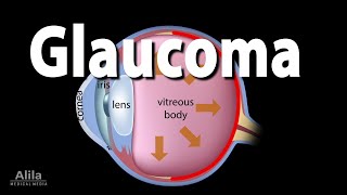 Development of Glaucoma Animation Open Angle vs Angle Closure Glaucoma [upl. by Karlens83]