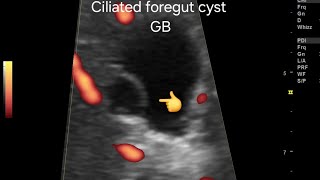 Ciliated foregut cyst of gallbladder very rare case ultrasound amp color Doppler overview [upl. by Aciria365]