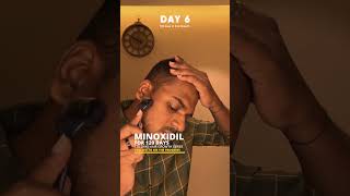 Derma rolling and Minoxidil for Hair Growth  Day 7 hairloss dermaroller hairgrowth minoxidil [upl. by Hacker]