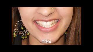 Invisalign for Adults A Better Way to a Straighter Smile [upl. by Jilly]