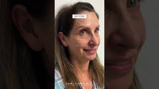 6 Months After Trifecta Lift Nanostem amp FullFace CO2  Dr Kami Parsa [upl. by Guerin21]