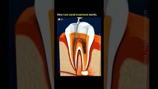 How Root Canal Treatment Works rootcanals howrootcanalworks rootcanal [upl. by Liatnahs699]