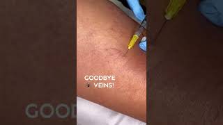 Treating spider veins with sclerotherapy ￼ [upl. by Bergman]