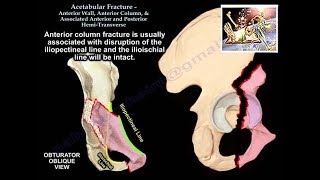 Acetabulum Anterior Wall Column HemiTransverse  Everything You Need To Know  Dr Nabil Ebraheim [upl. by Nordek]