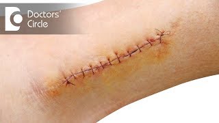 Scar treatment in Ranchi Scar revision surgery by Dr Pankaj Kumar M Ch shorts [upl. by Alleon]