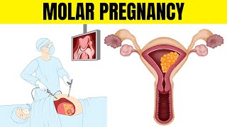 Molar Pregnancy Hydatidiform Mole  Types Causes Signs amp Symptoms Diagnosis And Treatment [upl. by Arehsat]