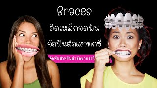 จัดฟัน ดัดฟัน ติดเหล็กจัดฟัน Dental Braces [upl. by Clough]