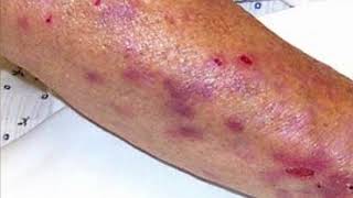 Cystic Acne on the Legs Pimples Pops amp Rashes Part 3 [upl. by Barraza]