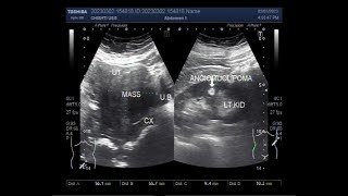 A large Fibroid and a small Renal Angiomyolipoma [upl. by Dlanod]