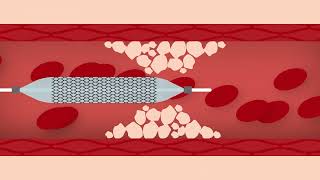 Heart Stent Procedure [upl. by Mortie566]