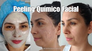 Peeling Químico Facial  Renueva tu Piel [upl. by Claudian]