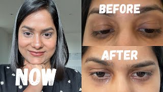 Xanthelasma Removal at Home  How I Removed Mine 3 Years Ago  Fatty Eye Cholesterol Deposit [upl. by Yvad]