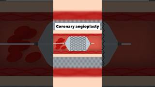 Coronary Angioplasty [upl. by Nedi]