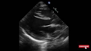 Overriding aorta in tetralogy of Fallot  Echo [upl. by Story]