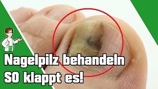 Nagelpilz behandeln  SO klappt es 👣💅 [upl. by Wendin]