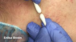 Pariss Acne Treatment Blackhead Extractions Part 1 [upl. by Airdnazxela]