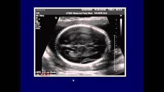 fetal biometry pptx [upl. by Janaye]