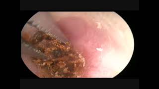 Gros bouchon de cérumen earwax removal JB DANVIN 1 [upl. by Klina53]