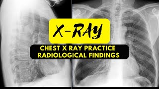 Chest X Ray Practice 37  Radiological Findings Bronchitis [upl. by Dadivitan483]