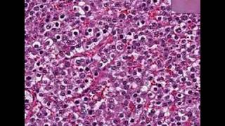 Histopathology Testis Seminoma [upl. by Anaed389]