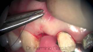 Connective tissue graft from tuberosity Dr Herminio García Roncero [upl. by Adnael620]