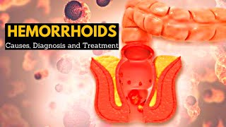 Hemorrhoids or Piles CausesSigns and symptoms Diagnosis and Treatment [upl. by Eniamerej907]