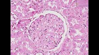 Histopathology Kidney Systemic lupus erythematosus [upl. by Picco]