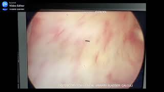 CYSTOSCOPY FOR VESICAL URINARY BLADDER CALCULI [upl. by Fidelas]